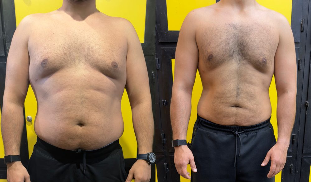Client before and after, clear fat loss through the chest and waist